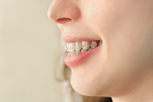 2-Stage-Braces