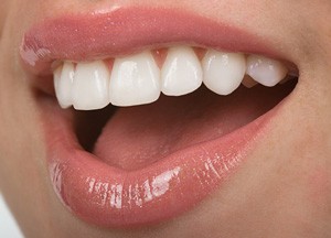 Porcelain-Veneers-web