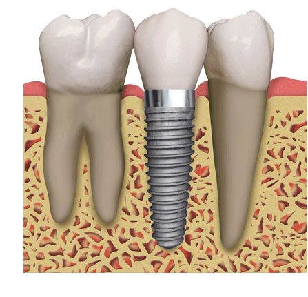 dental_implants