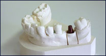 Dental Implants with Kingsville Dentist