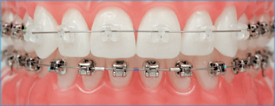 Damon Braces and Damon Clear Braces Damon Braces